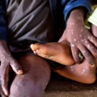 Kasus Mpox meningkat hingga 177 persen, dan jumlah kematian melonjak sebesar 38,5 persen dibandingkan dengan periode yang sama pada tahun sebelumnya