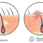 Rambut kemaluan yang tumbuh ke dalam adalah masalah umum yang terjadi setelah mencukur, dan dapat menimbulkan benjolan kecil, kemerahan, atau bahkan infeksi jika tidak ditangani dengan benar